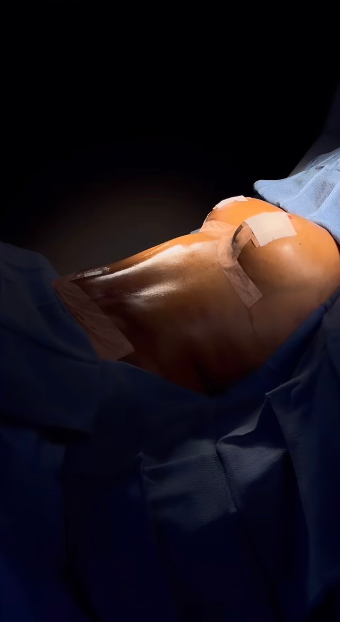 Tummy Tuck