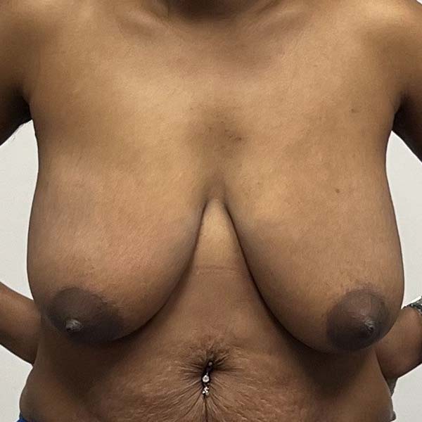 Before and After Breast Reduction in Houston