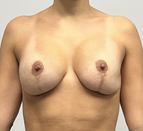 Breast Revision Before & After Gallery - Patient 93879243 - Image 1