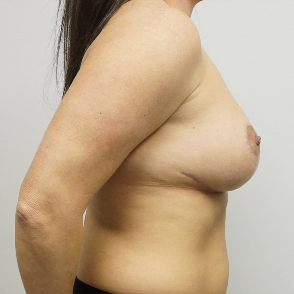 Breast Revision Before & After Gallery - Patient 93887995 - Image 4