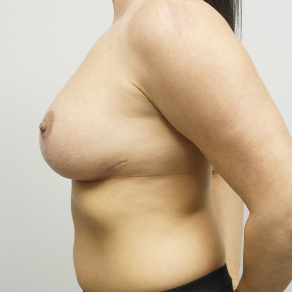 Breast Revision Before & After Gallery - Patient 93887995 - Image 6