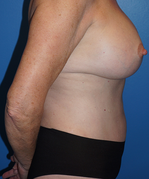 Mommy Makeover Before & After Gallery - Patient 93894345 - Image 6