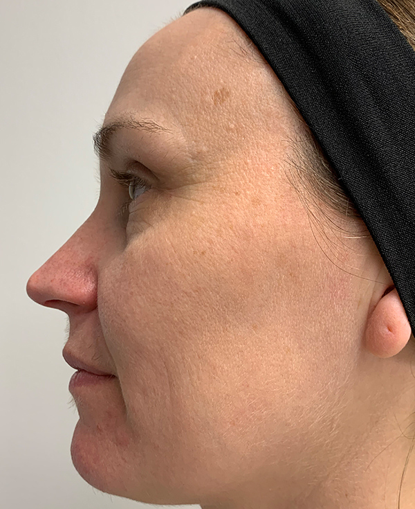 Halo Laser Before & After Gallery - Patient 93894513 - Image 5