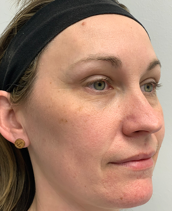 Halo Laser Before & After Gallery - Patient 93894513 - Image 10