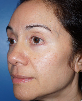 Halo Laser Before & After Gallery - Patient 93894531 - Image 6