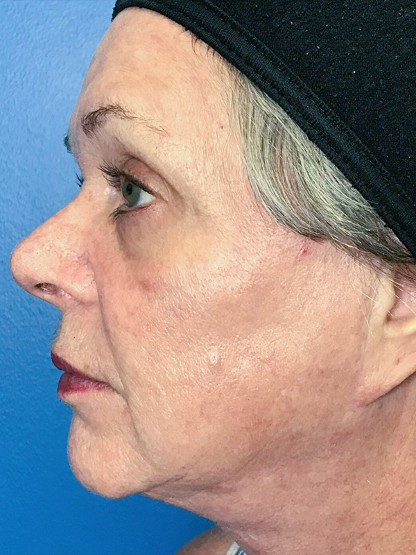 Halo Laser Before & After Gallery - Patient 93894613 - Image 6