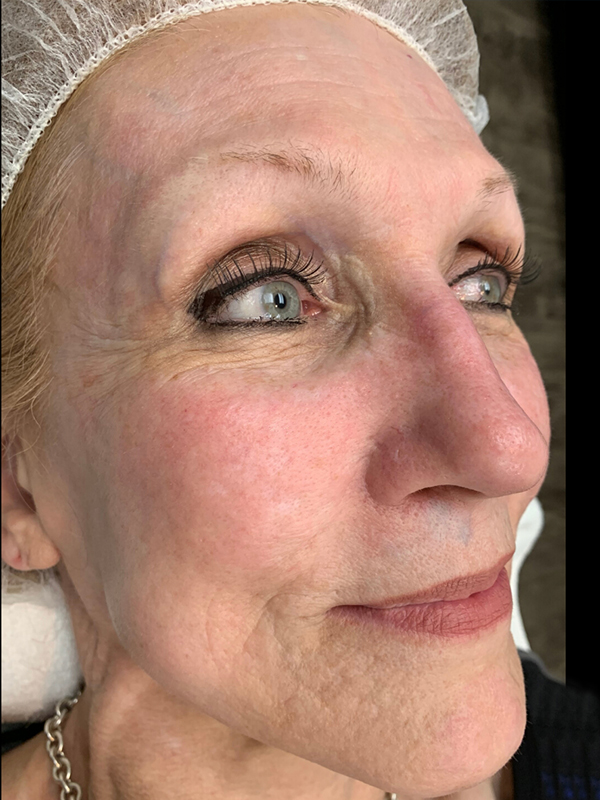 Halo Laser Before & After Gallery - Patient 93894678 - Image 6