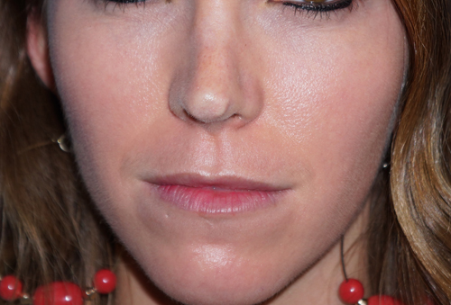 Non-Surgical Nose Job Before & After Gallery - Patient 93894679 - Image 1