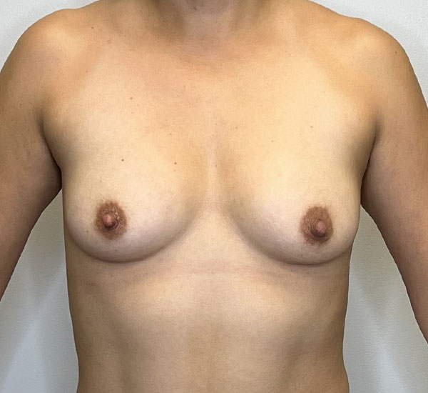 Before & After Breast Augmentation