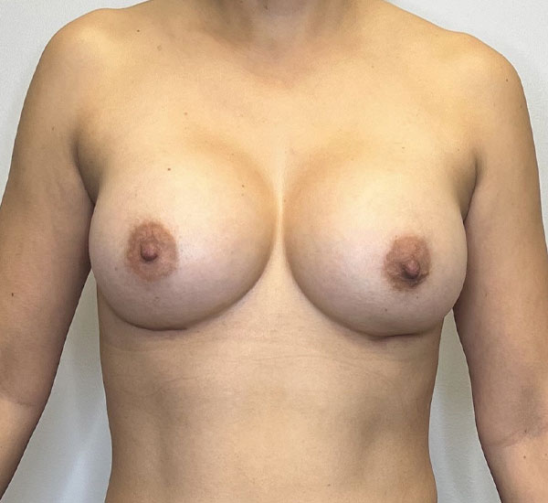 Before & After Breast Augmentation