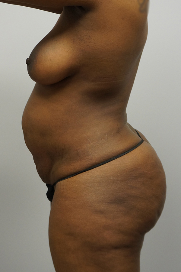 Tummy Tuck Before & After Gallery - Patient 93899002 - Image 3