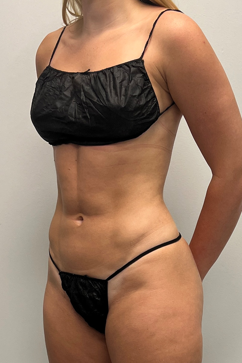 HD Liposuction 360  Before & After Gallery - Patient 417358 - Image 4