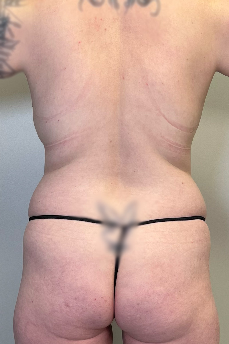 Tummy Tuck Before & After Gallery - Patient 149635 - Image 11