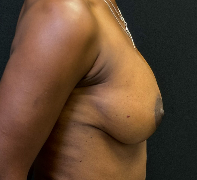 Breast Augmentation Before & After Gallery - Patient 278457 - Image 6