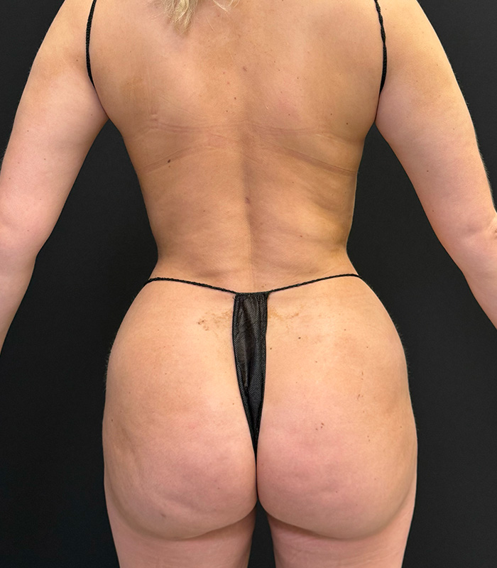 Brazilian Butt Lift Before & After Gallery - Patient 351080 - Image 2