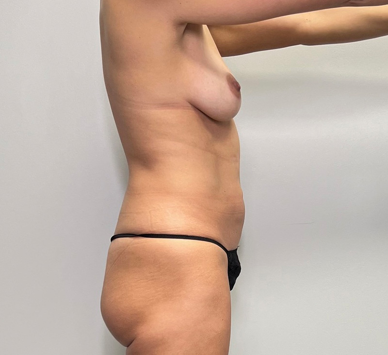 Bodytite Before & After Gallery - Patient 101473 - Image 7