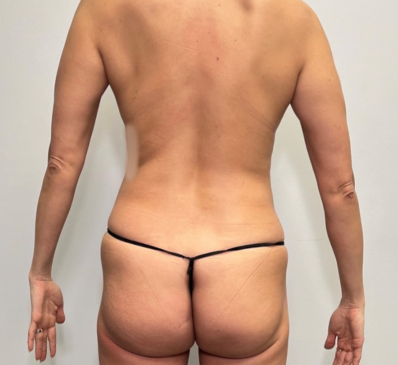 Brazilian Butt Lift Before & After Gallery - Patient 302927 - Image 1