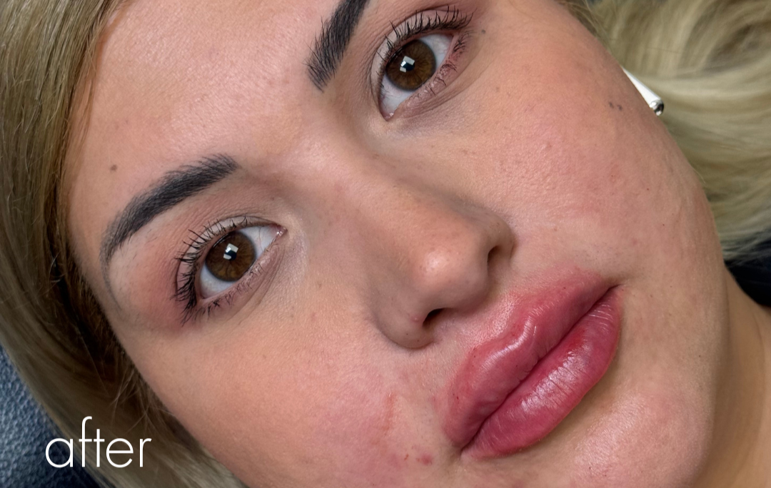 Lip Filler Before & After Gallery - Patient 999621 - Image 2