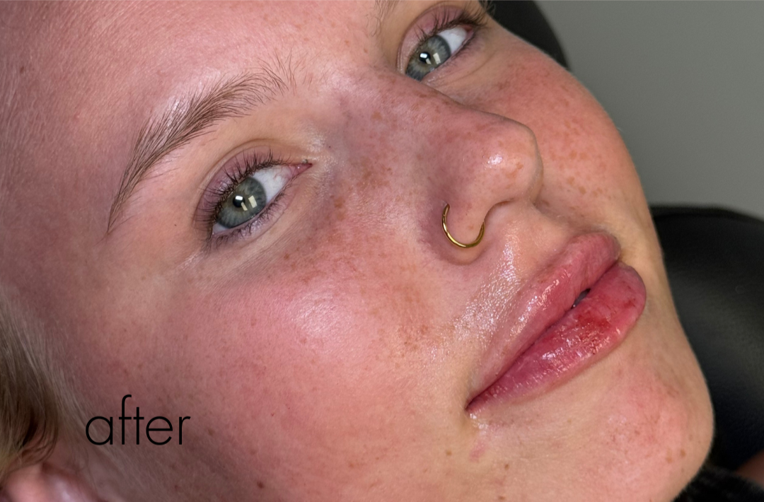 Lip Filler Before & After Gallery - Patient 326437 - Image 2