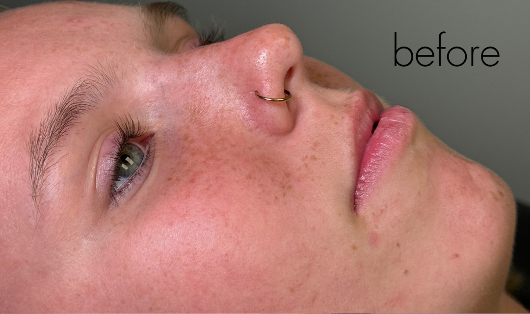 Lip Filler Before & After Gallery - Patient 326437 - Image 1