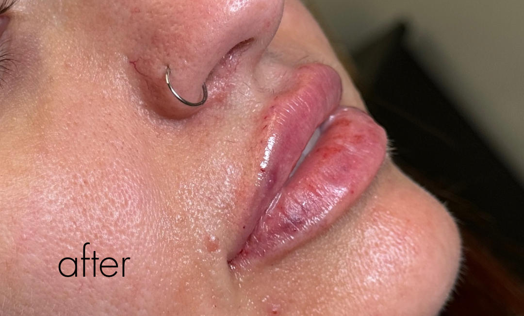 Lip Filler Before & After Gallery - Patient 176764 - Image 2