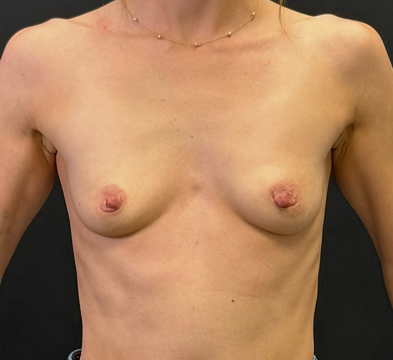 Breast Augmentation Before & After Gallery - Patient 447675 - Image 1