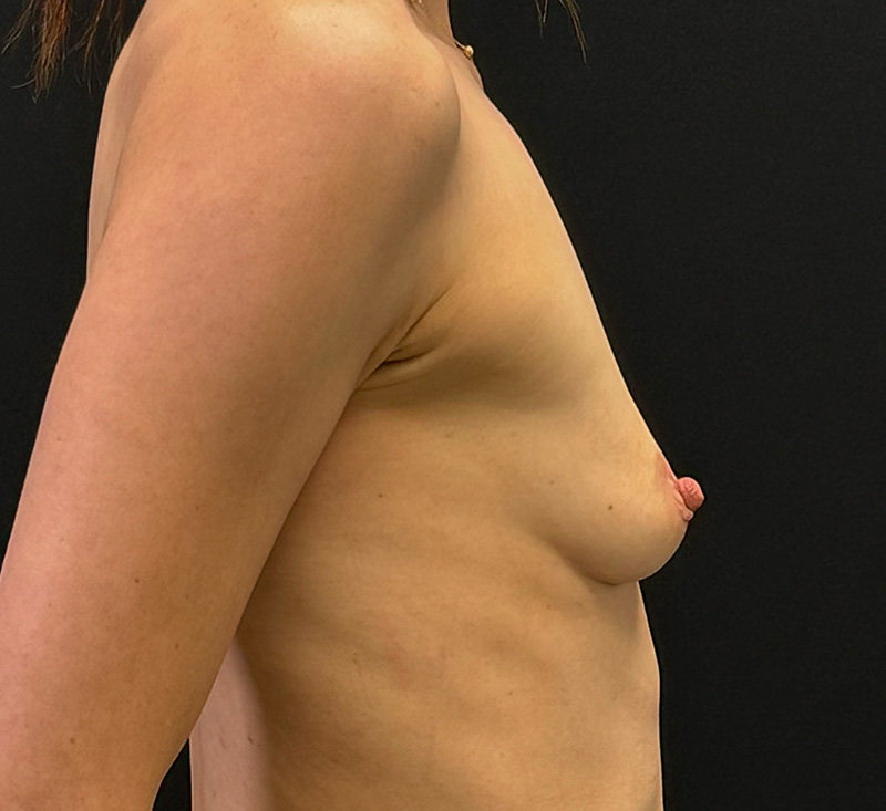 Breast Augmentation Before & After Gallery - Patient 447675 - Image 5