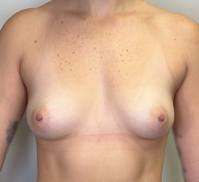 Breast Augmentation Before & After Gallery - Patient 163171 - Image 1