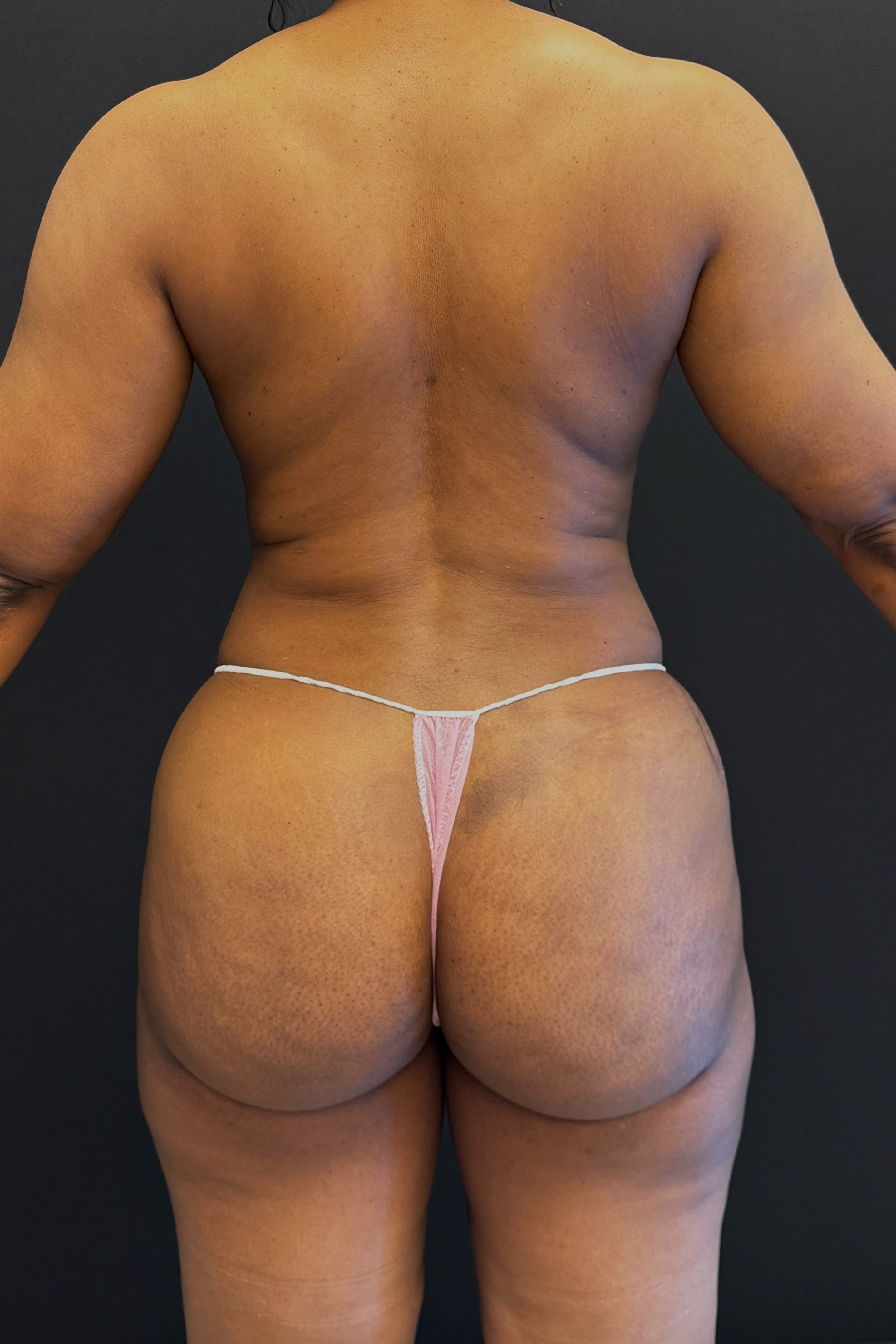 Brazilian Butt Lift Before & After Gallery - Patient 558598 - Image 2