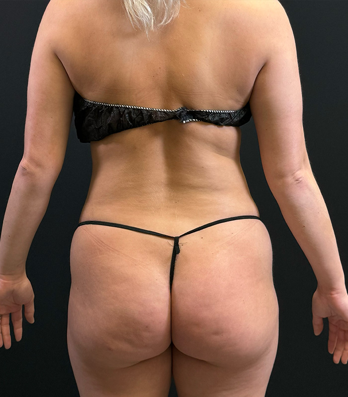 Brazilian Butt Lift Before & After Gallery - Patient 351080 - Image 1