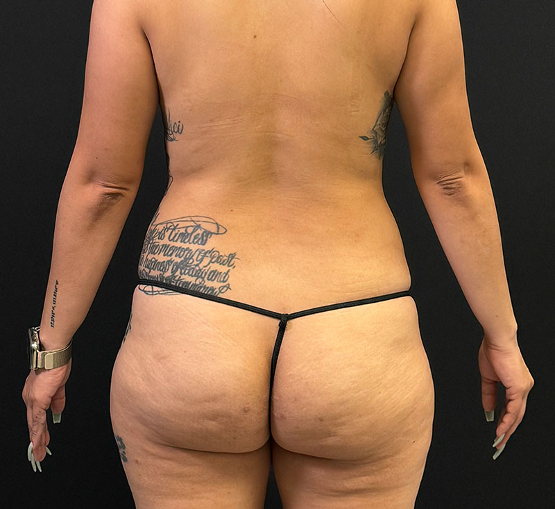 Brazilian Butt Lift Before & After Gallery - Patient 423426 - Image 1