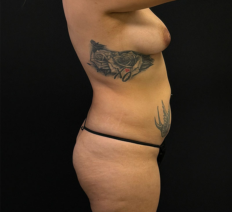 HD Liposuction 360  Before & After Gallery - Patient 334207 - Image 5