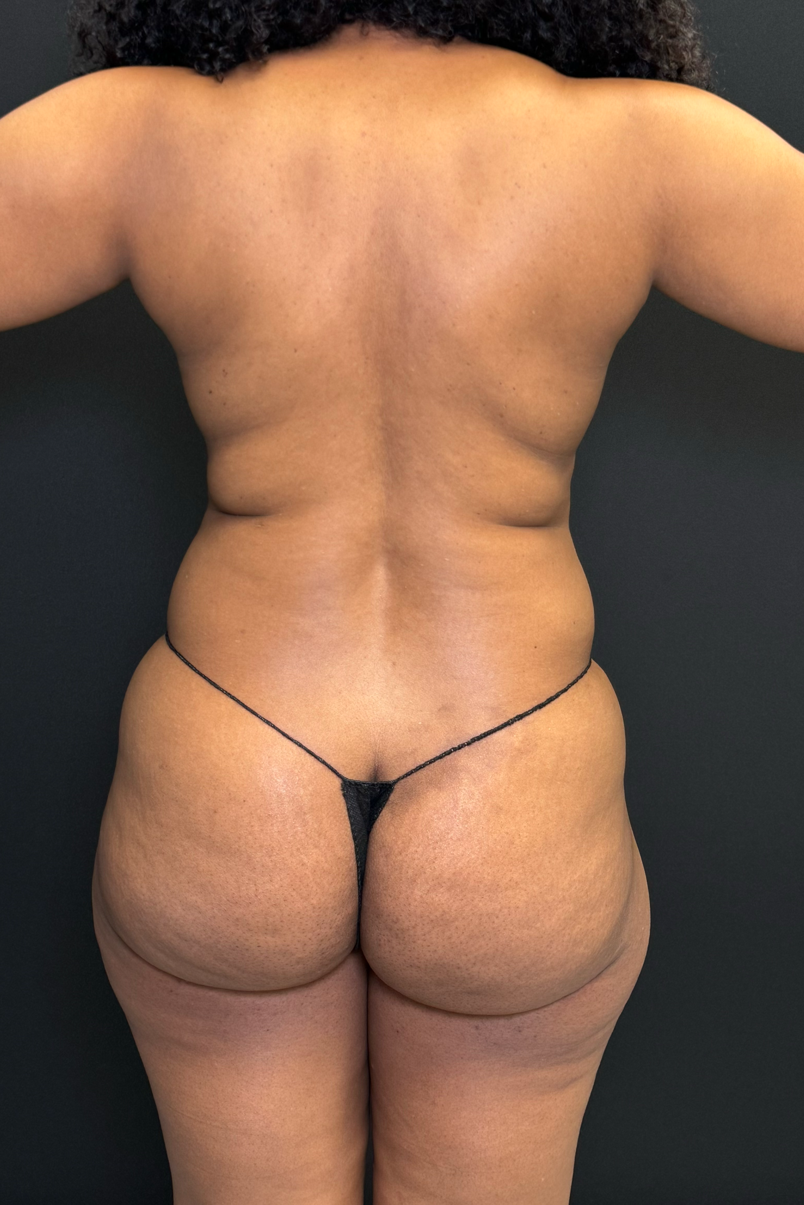 Brazilian Butt Lift Before & After Gallery - Patient 558598 - Image 1