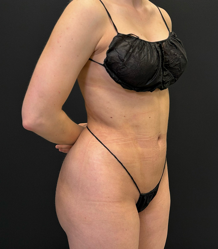 Before and After Photos of Vaser High-Def Liposuction in Houston TX